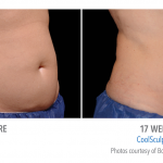 torrance-coolsculpting-stomach-weight-burn-fat-freeze