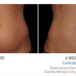 whittier-coolsculpting-stomach-weight-loss