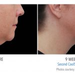 whittier-coolsculpting-under-chin-women-coolsculpting