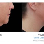 torrance-coolsculpting-under-chin-women-coolsculpting