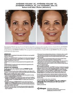 whittier-medical-Juvederm-before-after-Michele