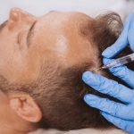 hair-loss-torrance-hair-restoration-treatment-near-me