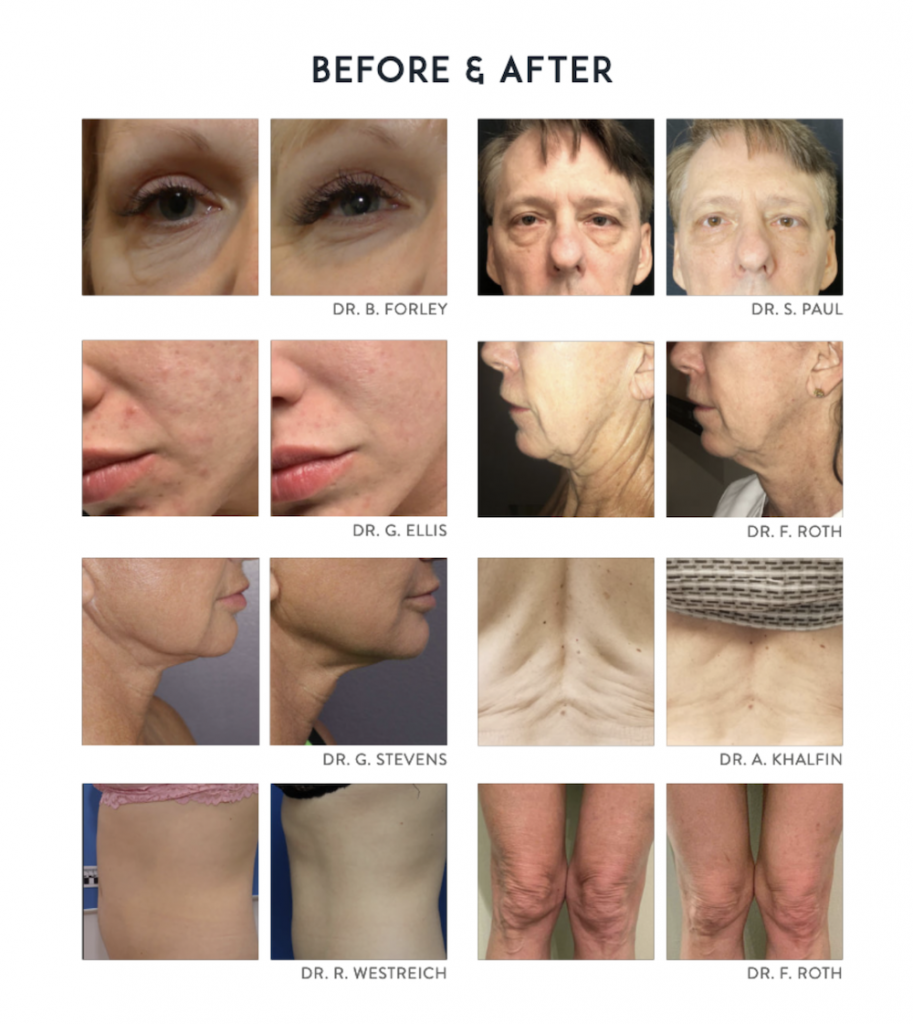 Morpheus8-microneedling-before-after-torrance-whittier-medical-spas