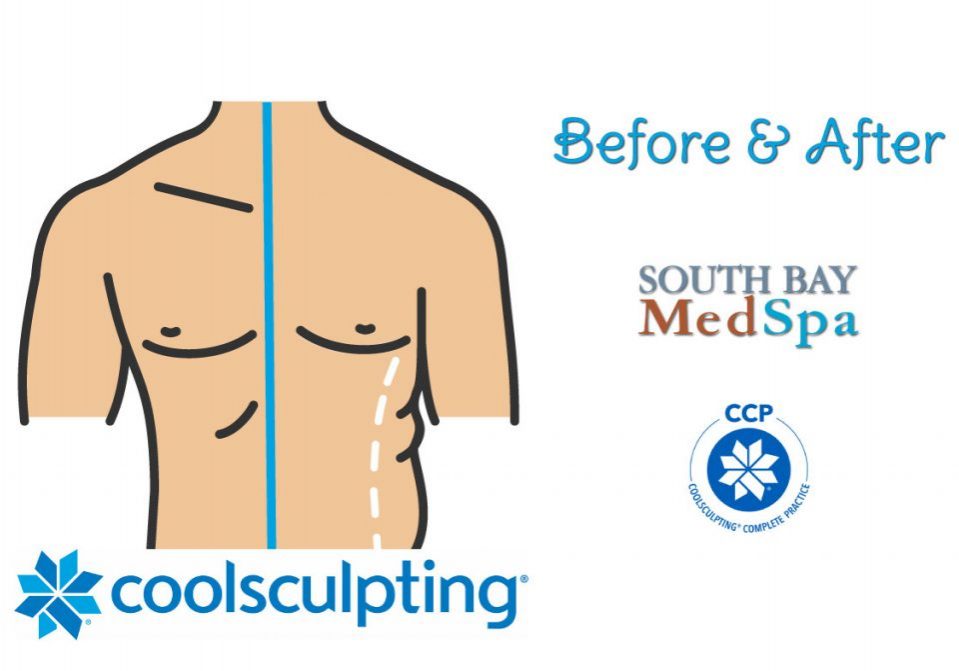 coolsculpting-mens-before-afters