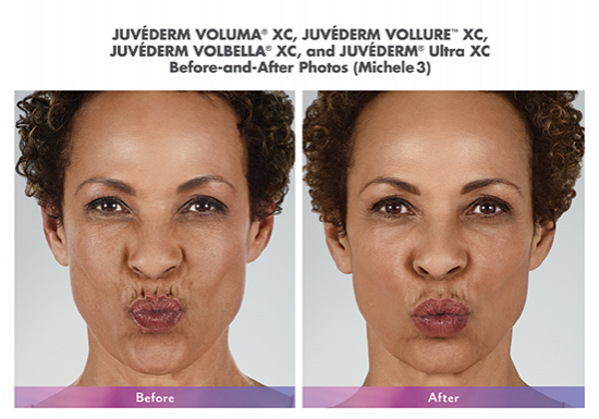 juvederm-before-after-torrance-medical-spa